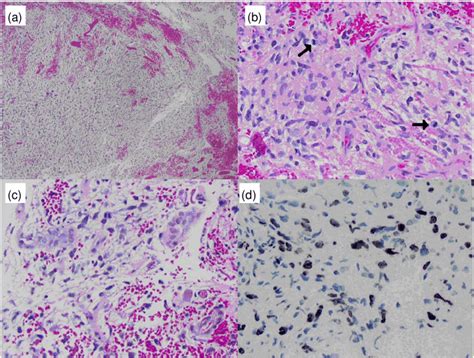 A H And E Stained Section Of Tumor Reveals An Infiltrating Neoplasm 4×