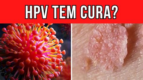 Existe Cura Ou Tratamento Para O V Rus Hpv Youtube