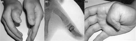 Z Thumb Deformity In Type Iii Polydactyly A Tight Capsule And Download Scientific Diagram