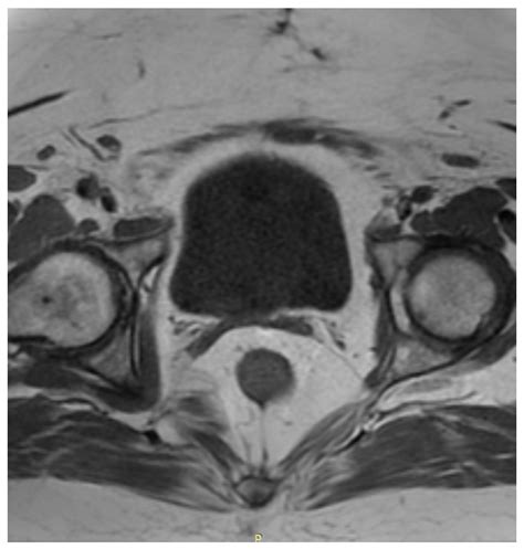 Ijerph Free Full Text Rhabdomyosarcoma Of The Cervix In A Post