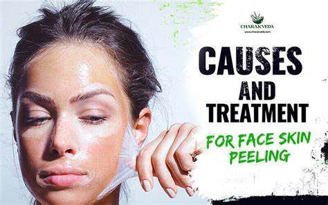 Causes and Treatment For Face Skin Peeling | Charakveda