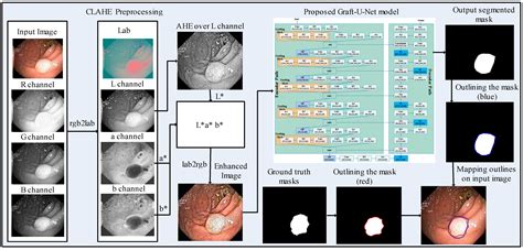 Gastrointestinal Tract Polyp Anomaly Segmentation On Colonoscopy Images