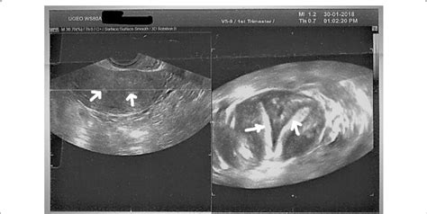 Uterine Didelphys Ultrasound