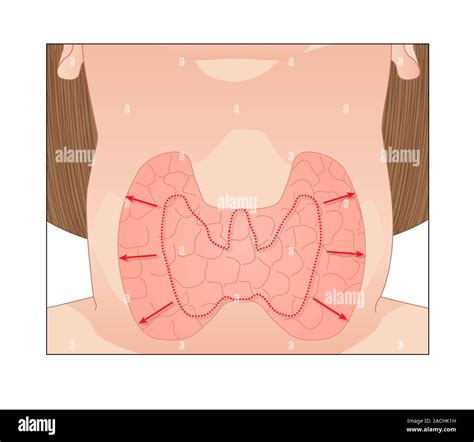 El bocio Ilustración de un agrandamiento de la glándula tiroidea