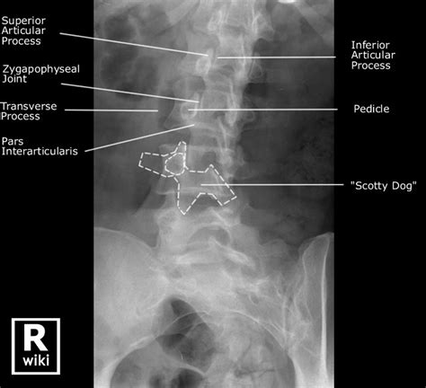Oblique Lumbar Diagram Quizlet
