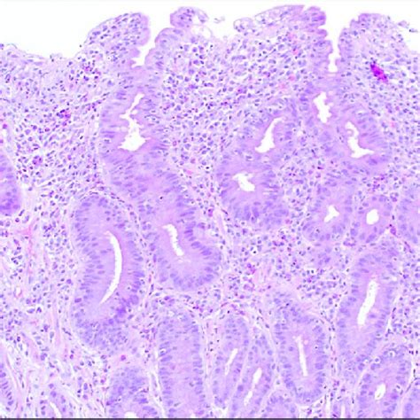 Biopsy From The Patients Second Portion Of Duodenum Showing Almost Download Scientific Diagram