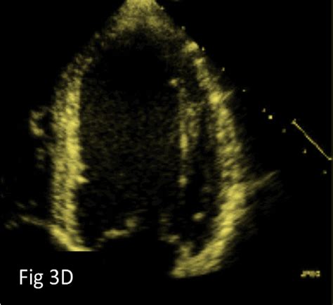 Dicas Para Otimizar A Imagem Ecocardiográfica Bidimensional 2d Parte 2 Blog Ecope