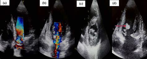 Resting Transthoracic Echocardiography Images A Apical 5 Chamber