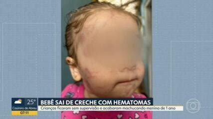 Beb Agredida Em Creche Fica V Rios Hematomas E Fam Lia Alega