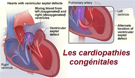 Les Cardiopathies Cong Nitales Sant M Decine