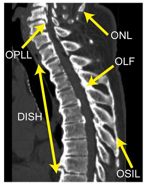 Jcm Free Full Text Association Between Severity Of Diffuse Idiopathic Skeletal Hyperostosis