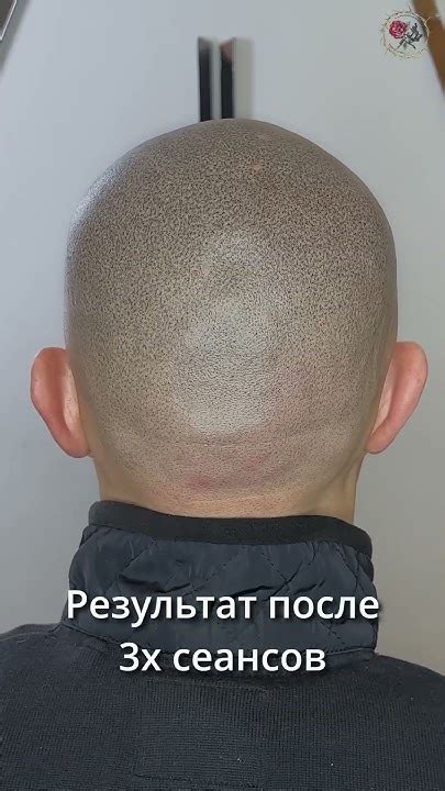 Тотальная алопеция скрыта. Трихопигментация без окантовки. Scalp ...