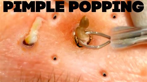 Best Pimple Popping Videos Of 2021 Youtube