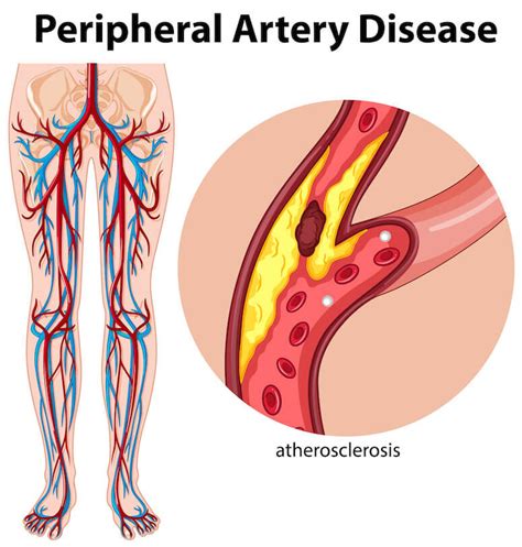 What Causes Poor Circulation In Legs Vascular Surgery Specialist