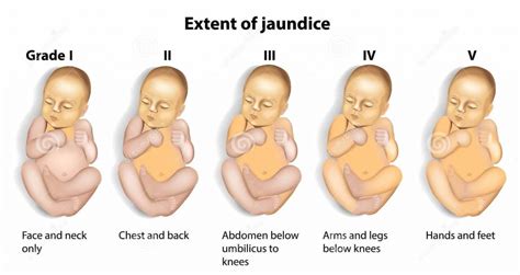 Cara Menghitung Derajat Ikterus Neonatus Kramer