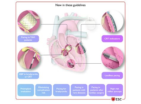 The 2021 Esc Guidelines On Cardiac Pacing And Crt Present New And