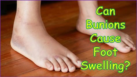 Can Bunions Cause Foot Swelling on Top of Foot? - BUNION DR