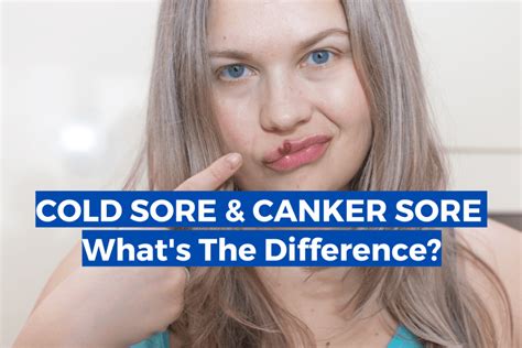 Cold Sore Vs Canker Sore What Are The Differences