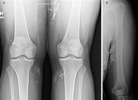 Dermatomyositis Presenting With Diffuse Calcinosis BMJ Case Reports