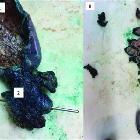 Macroscopically The Ductus Choledochus Is Filled With A Yellowish