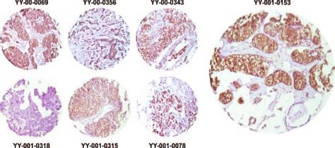 Tissue Microarray Analysis Of 14 3 3 Expression In Breast Carcinomas