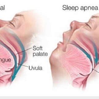 Demonstration Of The Changes In The Pharyngeal Airway Space Following