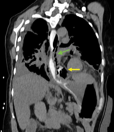 CT Esophagography For Evaluation Of Esophageal Perforation RadioGraphics