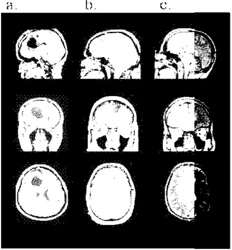 Sagittal, coronal and axial T1 weighted MRI images of the anterior ...