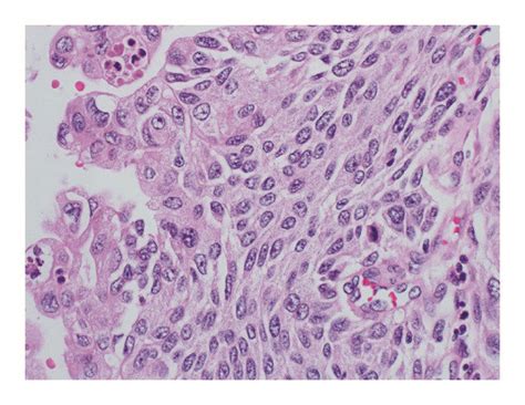 Photomicrograph Depicting High Grade Urothelial Carcinoma With