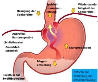 Refluxkrankheit Wenn Sodbrennen Krankheitswert Bekommt