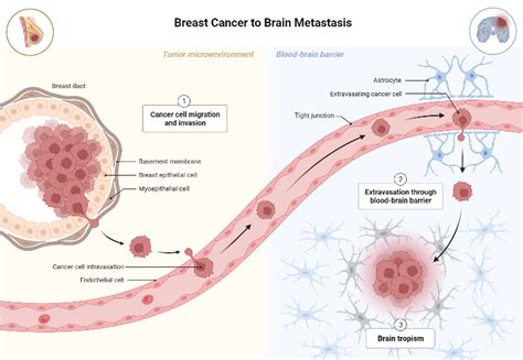 Breast Cancer To Brain Metastasis BioRender Science Templates