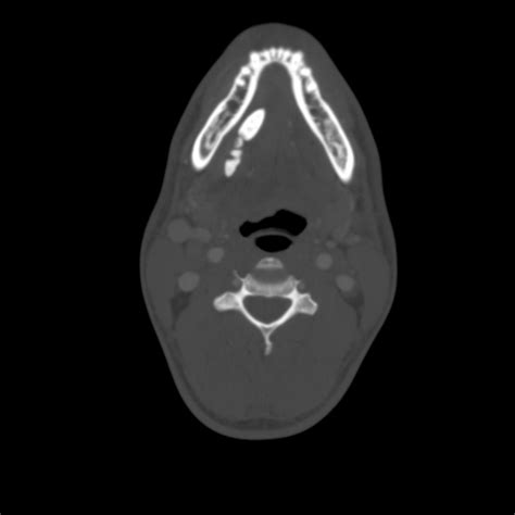 Sialadenitis Secondary To Sialolithiasis Image