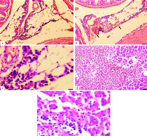 Liquefactive Necrosis Pancreas