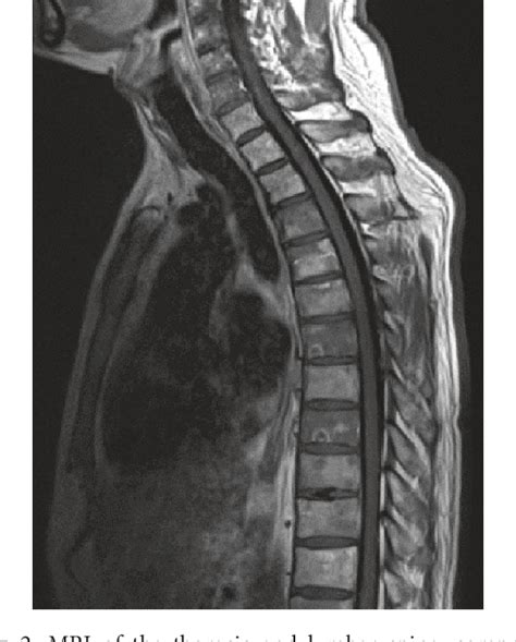 Figure 2 From R Inguinal R Scrotum Extramammary Paget S Disease With Diffuse Spine Metastasis