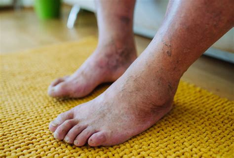 Diabetic Peripheral Neuropathy Causes Symptoms