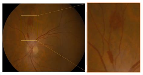 Colour Fundus Photography Cobra HD Fundus Camera CSO Florence