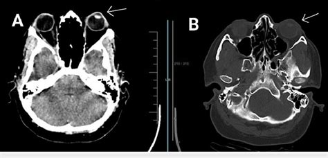 CT brain scan of the patient shows the proptosis of the left eye. (A)... | Download Scientific ...