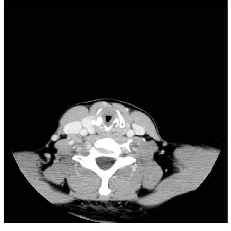 Ct Scan Axial View Showing Circumferential Nonenhanced Soft Tissue Download Scientific Diagram