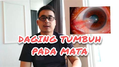 CARA MENGOBATI DAGING TUMBUH PADA MATA PTYRIGIUM PADA MATA YouTube