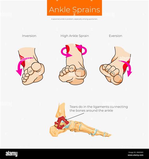 Types Of Ankle Sprain Scheme Poster Stock Vector Image Art Alamy