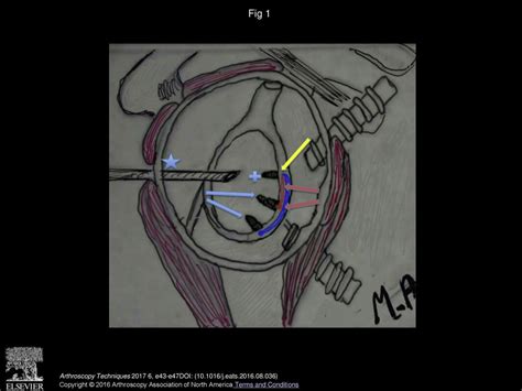 The Double Bankart Bridge A Technique For Restoration Of The Labral