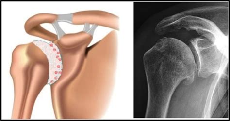 Arthrose De L Paule Ou Omarthrose Groupe Clinique Drouot