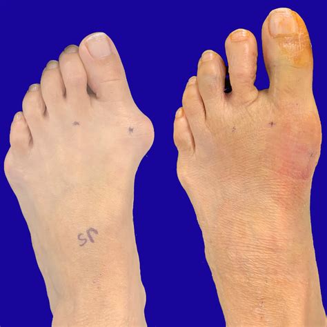 Before and After Bunion Surgery Photos | The Bunion Cure