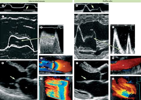 Mitral Stenosis The Lancet