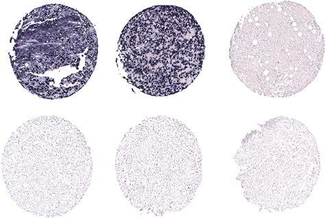 Figure 2 From Epstein Barr Virus Positive Diffuse Large B Cell Lymphoma