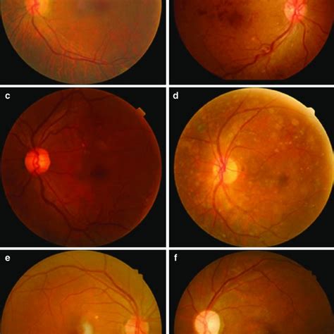 1 Disagreement In Detecting Diabetic Macular Edema Dme Among Deep Download Scientific Diagram