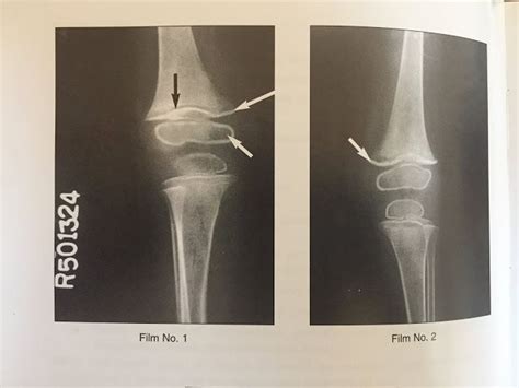 medical school: XRAY OF SCURVY DISEASE | X ray, Disease, Medical