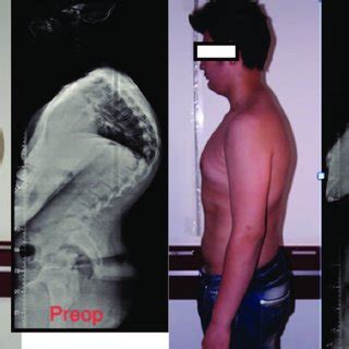 Preoperative Left Side And Postoperative Right Side Full Body