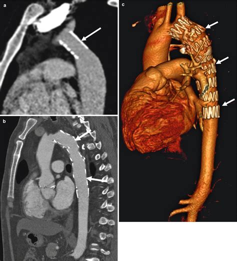 Aortic Coarctation Repairs | Thoracic Key