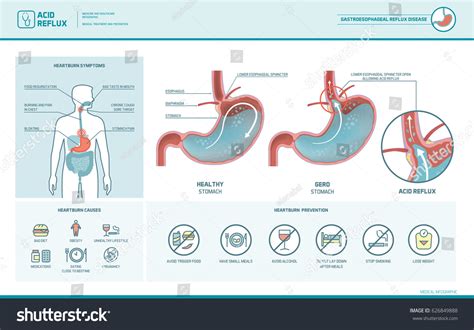 Acid Reflux Heartburn Gerd Infographic Stomach Stock Vector